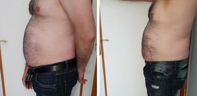 Cryo Evo 3D - appareil professionnel alternative à la liposuccion par  cryolipolyse