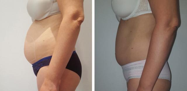 Cryo Evo 3D - appareil professionnel alternative à la liposuccion par  cryolipolyse