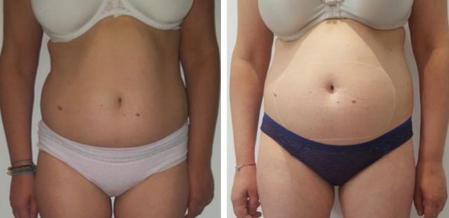 Cryo Evo 3D - appareil professionnel alternative à la liposuccion par  cryolipolyse